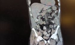 Midesinde getirdiği uy*şturucu ameliyatla çıkarıldı