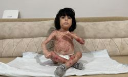 4 yaşındaki İbrahim, 'Kelebek hastalığı' nedeniyle kıyafet giyemiyor