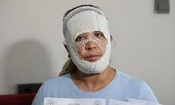 Güzelleşmek uğruna gittiği merkezde yüzü yandı