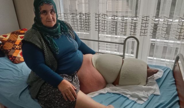 Fil hastalığı bacağını 100 kilo yaptı, tedavisinin devamı için destek bekliyor