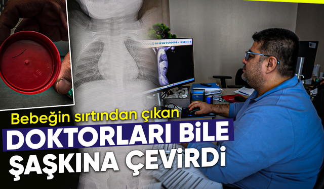 1 yaşındaki bebeğin sırtından çıkan şey doktorları bile şaşkına çevirdi