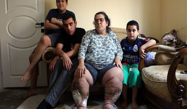 Fil hastası kadın, iyileşip çocuklarıyla ilgilenmek istiyor